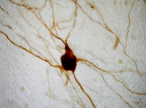 Parkinson : les neurones greffés chez les patients restent fonctionnels plus de 14 ans après